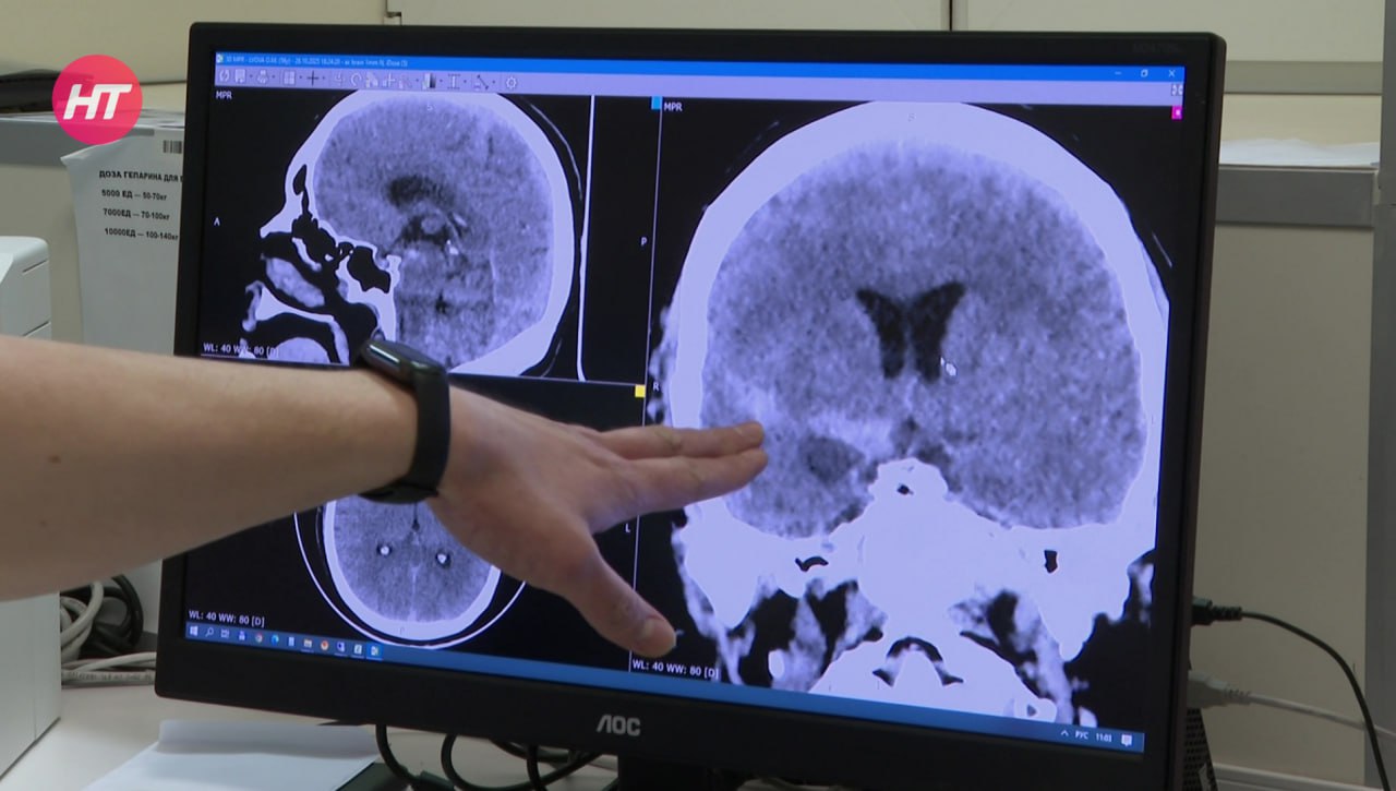 Сегодня отмечают Всемирный день борьбы с инсультом Сегодня отмечают Всемирный день борьбы с инсультом