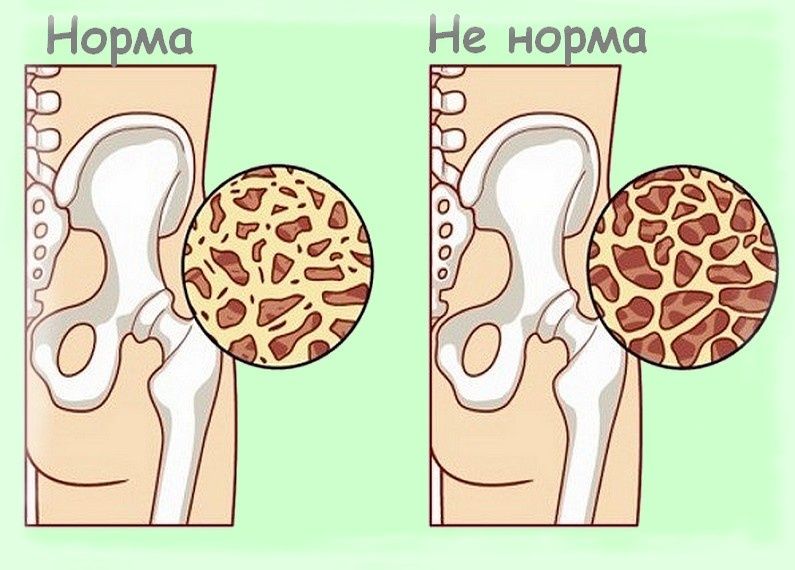 Как укрепить кости после 55 лет: не только молочные продукты